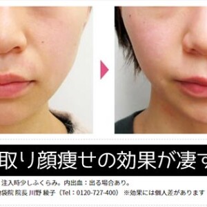 1日脂肪取り顔痩せの効果が凄い！何ccがベスト？顔と頬の脂肪を即効で落とす顔やせ注射！