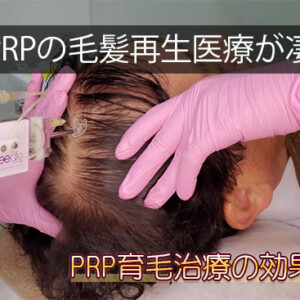 PRP育毛治療が安いクリニック！PRP注射を使った薄毛治療・毛髪再生医療の発毛効果は？