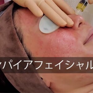 ヴァンパイアフェイシャル(ACRSダーマペン)が安いおすすめクリニック！効果とダウンタイムは？